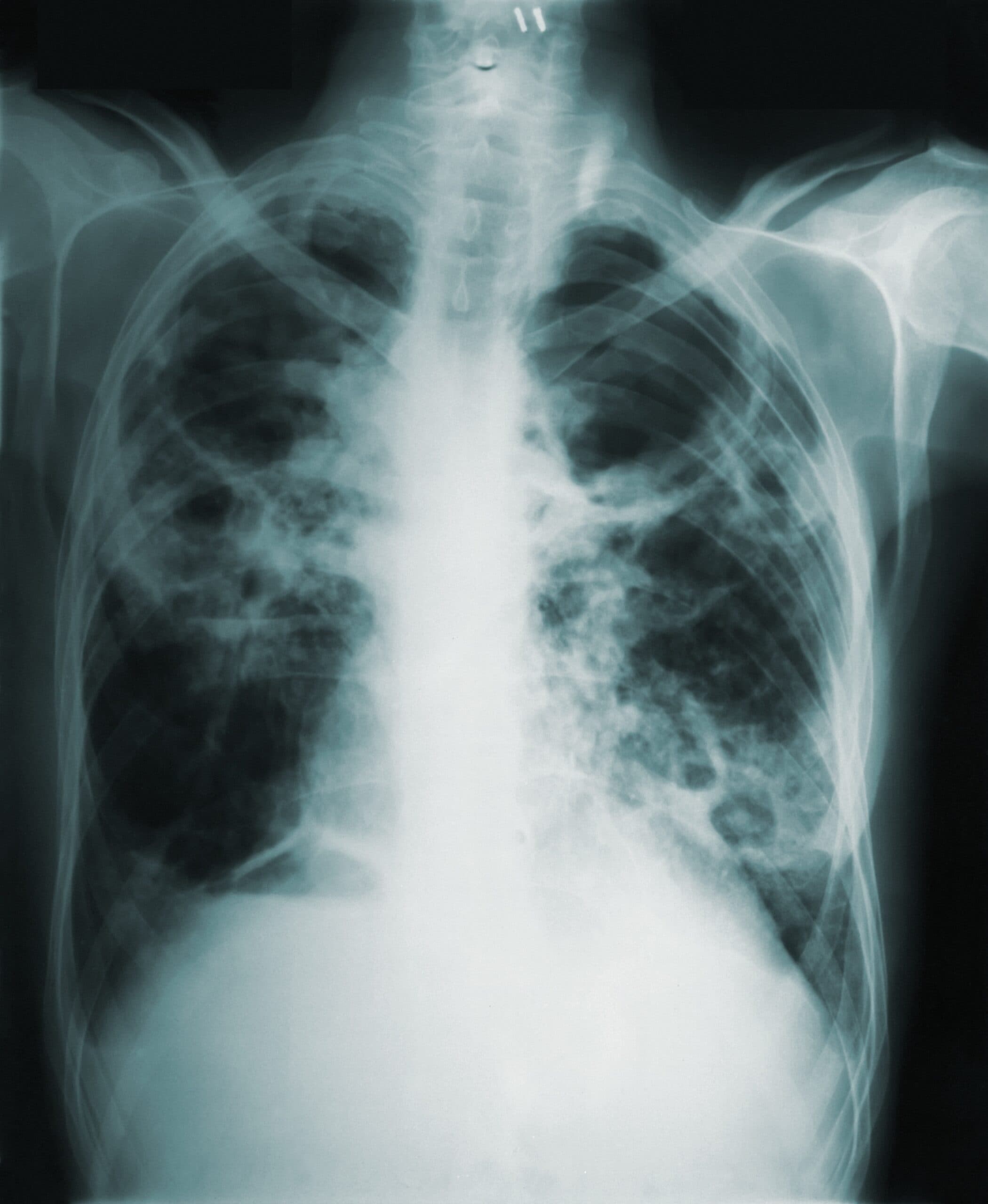Tuberculosis – the disease of the disadvantaged