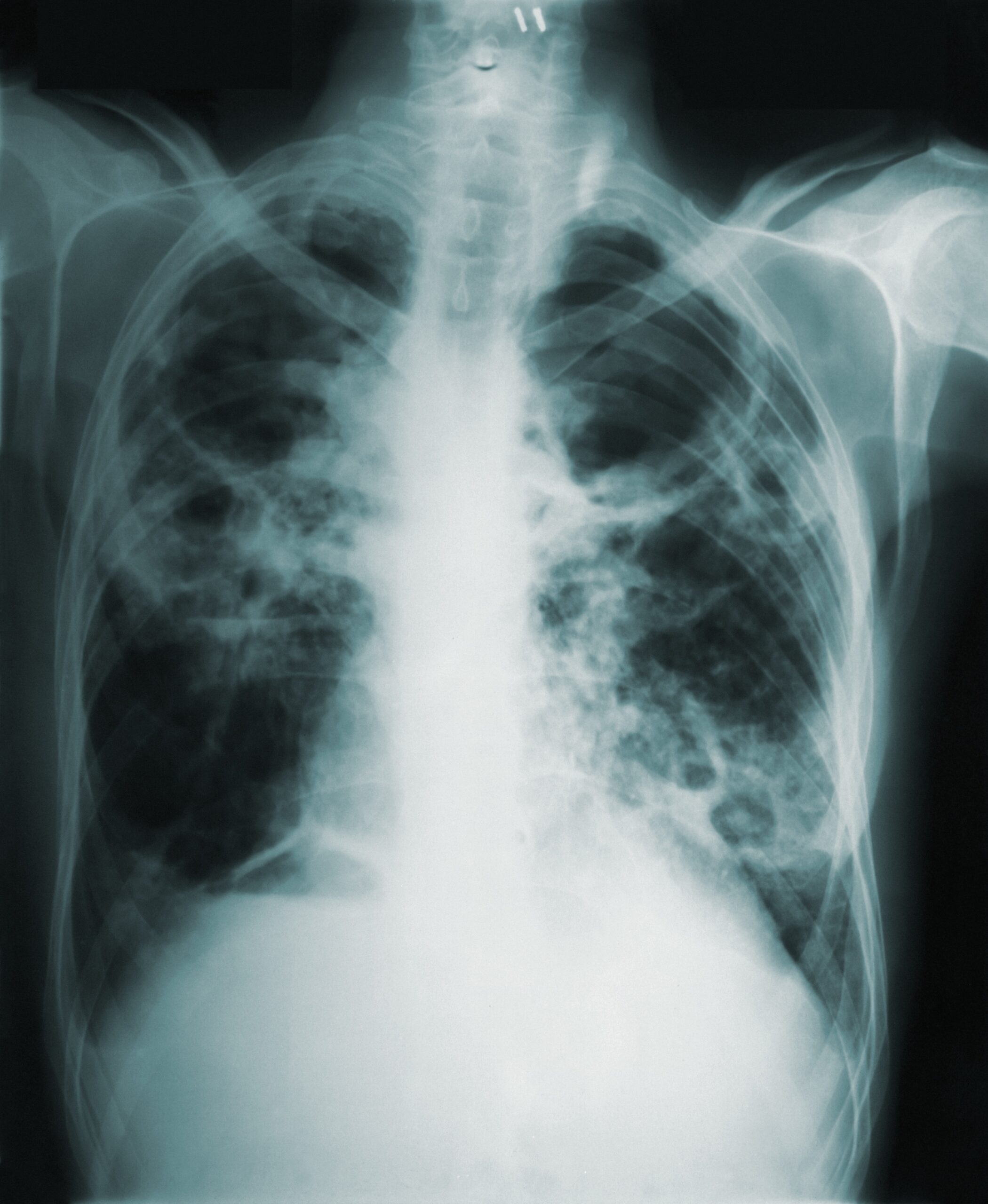 X-ray of body